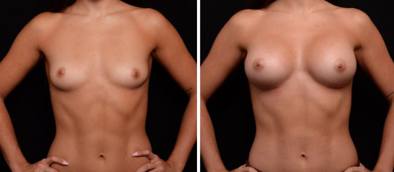 Shape: Mentor CPG Teardrop | Size: 375cc | Result Shown: 3 Months Post Surgery | Plastic Surgeon: Dr Luke Stradwick