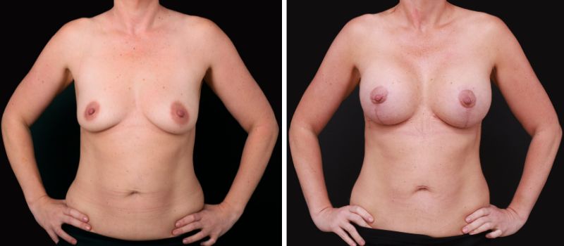 Size: 380cc | Results Shown: 3 Months Post Surgery | Plastic Surgeon: Dr Luke Stradwick