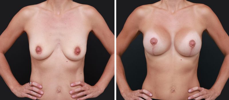 Size: 340cc | Results Shown: 4 Months Post Surgery | Plastic Surgeon: Dr Luke Stradwick