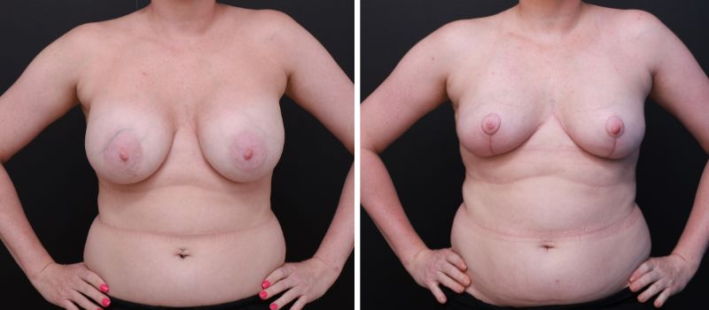 Result Shown: 3 Months Post Surgery | Plastic Surgeon: Dr Luke Stradwick