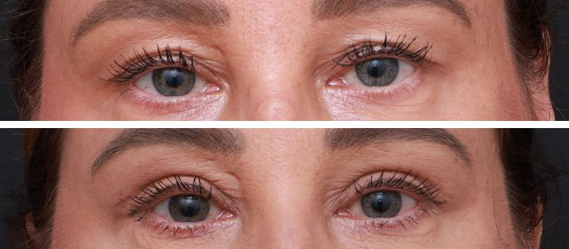 Results Shown: 4 Weeks Post Surgery | Plastic Surgeon: Dr Luke Stradwick