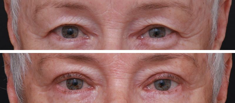 Results Shown: 5 Months Post Surgery | Plastic Surgeon: Dr Luke Stradwick