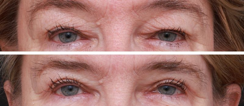 Results Shown: 4 Months Post Surgery | Plastic Surgeon: Dr Luke Stradwick