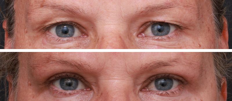 Results Shown: 6 Weeks Post Surgery | Plastic Surgeon: Dr Luke Stradwick