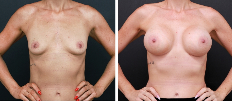 Shape: Mentor CPG Teardrop | Size: 375cc | Result Shown: 4 Months Post Surgery | Plastic Surgeon: Dr Luke Stradwick