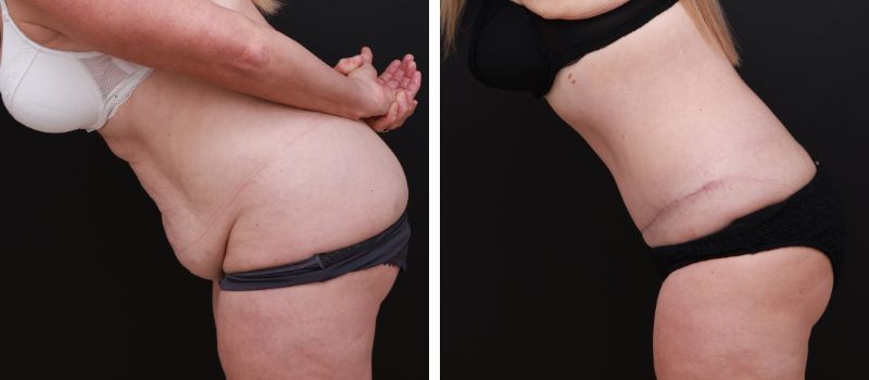 Results Shown: 4 Months Post Surgery