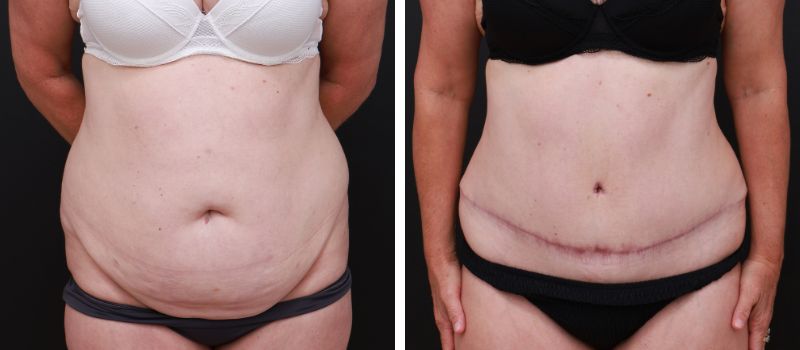 Results Shown: 4 Months Post Surgery