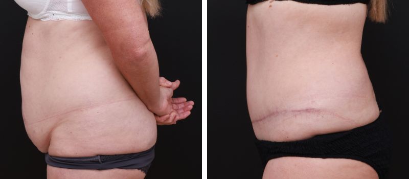 Results Shown: 4 Months Post Surgery