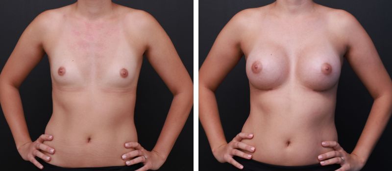Shape: Motiva Ergonomix | Size: 285cc | Result Shown: 3 Months Post Surgery | Plastic Surgeon: Dr Mike Yang