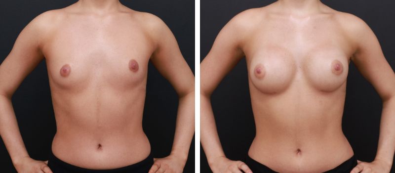 Shape: Motiva Ergonomix | Size: 265cc | Result Shown: 3.5 Months Post Surgery | Plastic Surgeon: Dr Mike Yang