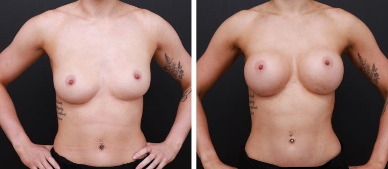 Shape: Motiva Round | Size: 400cc | Result Shown: 6.5 Months Post Surgery | Plastic Surgeon: Dr Mike Yang