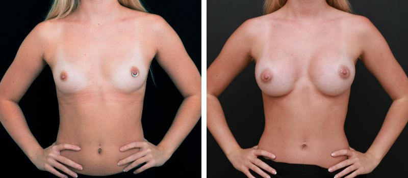 Shape: Motiva Ergonomix | Size: 245cc | Result Shown: 3 Months Post Surgery | Plastic Surgeon: Dr Mike Yang
