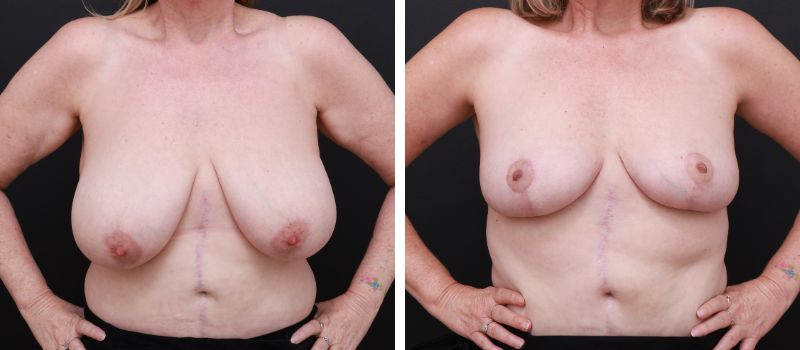 Results Shown: 3 Months Post Surgery  | Plastic Surgeon: Dr Mike Yang