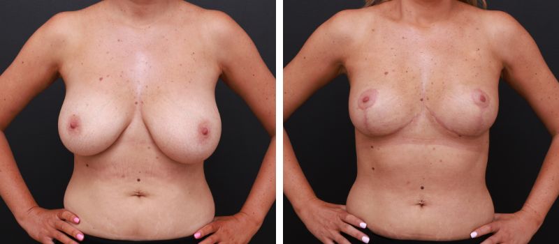Results Shown: 3 Months Post Surgery  | Plastic Surgeon: Dr Mike Yang