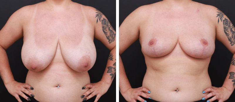 Results Shown: 3 Months Post Surgery  | Plastic Surgeon: Dr Mike Yang