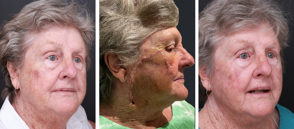 Procedure: Wide Local Excision of Melanoma on Right Cheek with Flap Repair Image 1: Pre Surgery Image 2: 7 Days Post Surgery Image 3: 3 Months Post Surgery