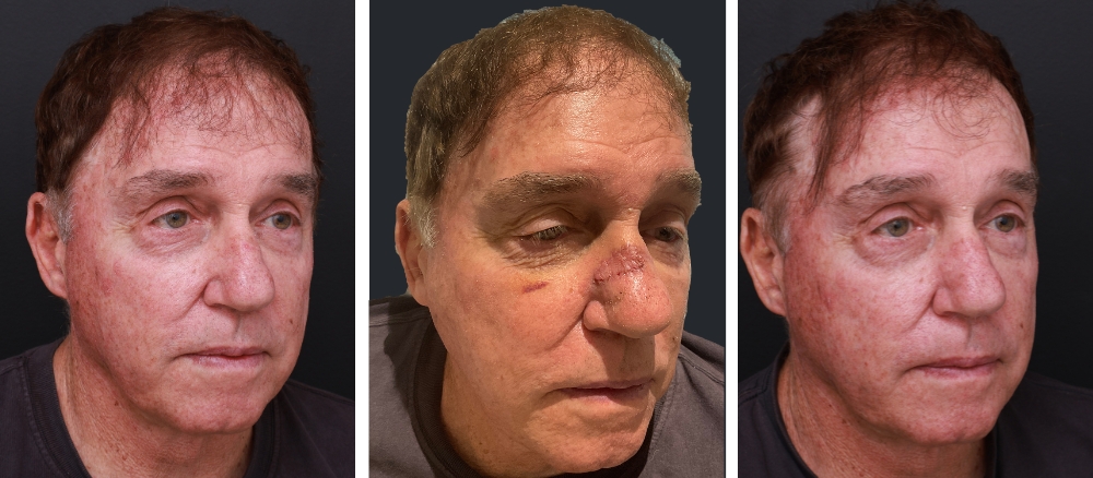 Procedure: Excision of Basal Cell Carcinoma on Nose with Flap Repair Image 1: Pre Surgery Image 2: 7 Days Post Surgery Image 3: 2 Months Post Surgery