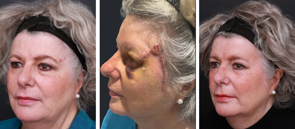 Procedure: Wide Local Excision of Melanoma on Left Temple with Flap Repair Image 1: Pre Surgery Image 2: 7 Days Post Surgery Image 3: 8 Months Post Surgery