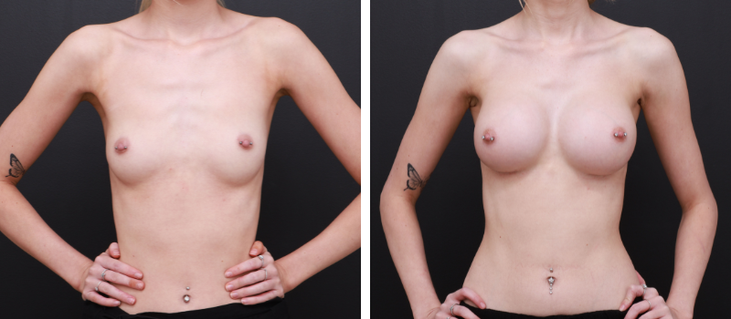 Shape: Motiva Ergonomix | Size: 340cc | Result Shown: 3 Months Post Surgery | Plastic Surgeon: Dr Mike Yang