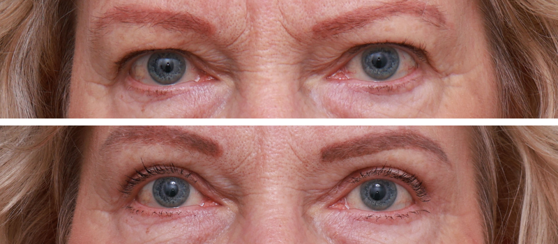 Results Shown: 9 Months Post Surgery | Plastic Surgeon: Dr Luke Stradwick