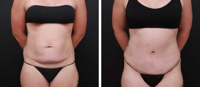 Results Shown: 3 Months Post Surgery