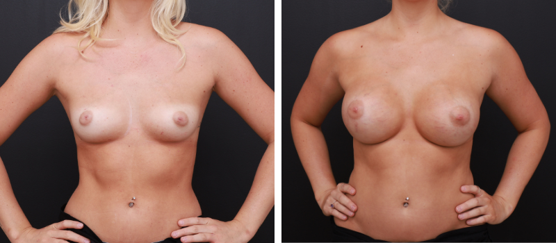 Shape: Motiva Ergonomix | Size: 380cc | Result Shown: 2 Months Post Surgery | Plastic Surgeon: Dr Luke Stradwick