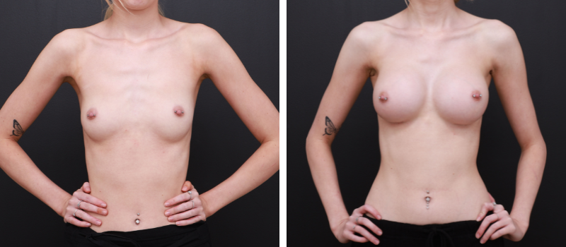 Shape: Motiva Ergonomix | Size: 340cc | Result Shown: 3 Months Post Surgery | Plastic Surgeon: Dr Mike Yang