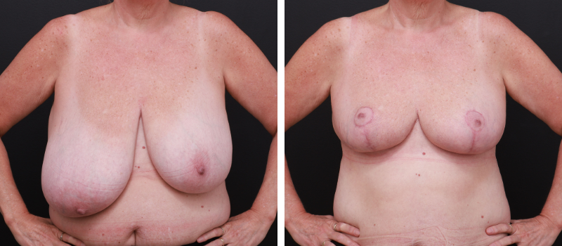 Results Shown: 3 Months Post Surgery | Plastic Surgeon: Dr Mike Yang