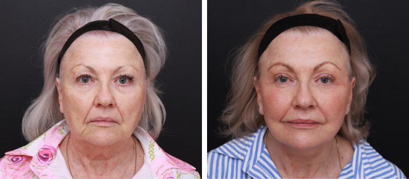 Result Shown: 6 Months Post Surgery