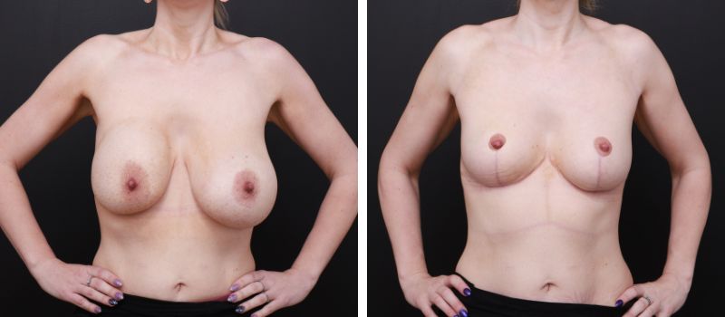 Result Shown: 4 Months Post Surgery | Plastic Surgeon: Dr Luke Stradwick