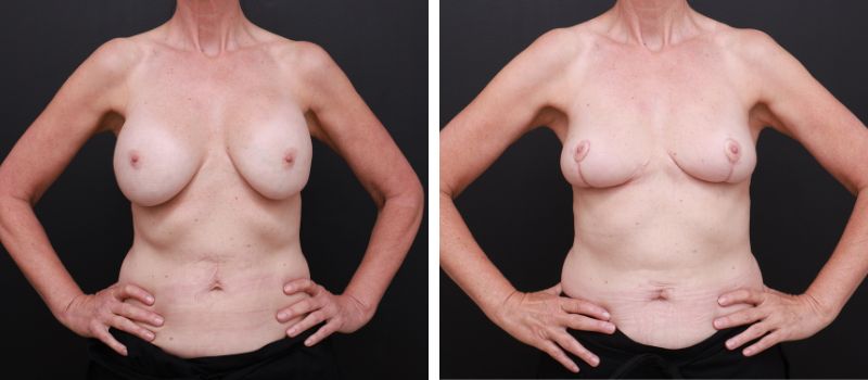 Result Shown: 3 Months Post Surgery | Plastic Surgeon: Dr Luke Stradwick