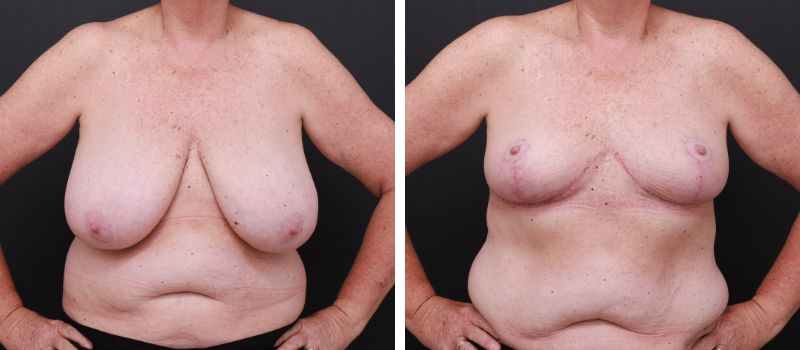 Results Shown 3 Months Post Surgery | Plastic Surgeon: Dr Luke Stradwick