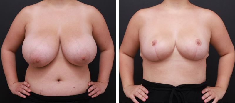 Results Shown 3 Months Post Surgery | Plastic Surgeon: Dr Luke Stradwick