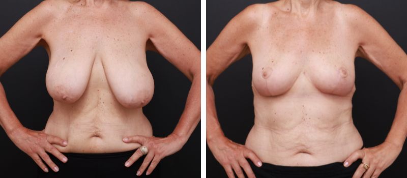 Results Shown 2 Months Post Surgery | Plastic Surgeon: Dr Luke Stradwick