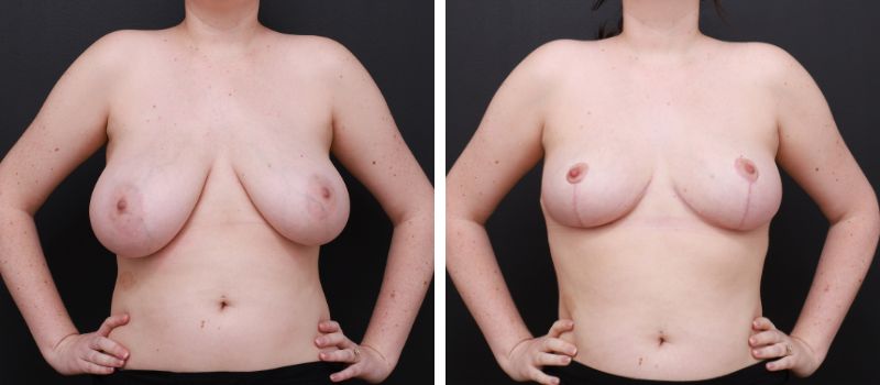 Result Shown: 4 Months Post Surgery | Plastic Surgeon: Dr Luke Stradwick