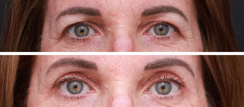 Results Shown: 3 Months Post Surgery | Plastic Surgeon: Dr Luke Stradwick