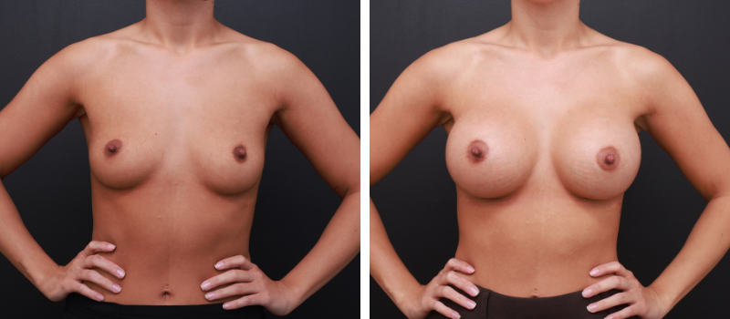 Shape: Mentor Round | Size: 450cc | Result Shown: 8 Weeks Post Surgery | Plastic Surgeon: Dr Daniel Williams