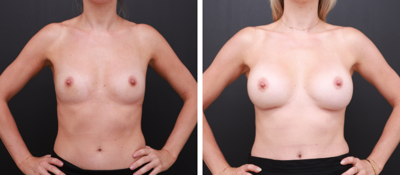 Shape: Motiva Ergonomix | Size: 340cc | Result Shown: 12 Months Post Surgery | Plastic Surgeon: Dr Daniel Williams