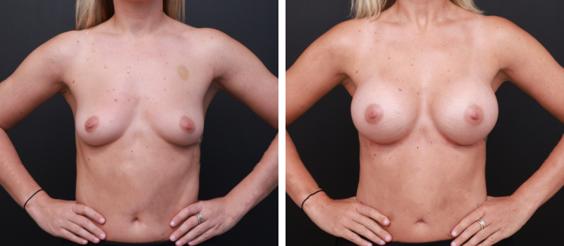 Shape: Motiva Ergonomix | Size: 300cc | Result Shown: 8 Weeks Post Surgery | Plastic Surgeon: Dr Daniel Williams