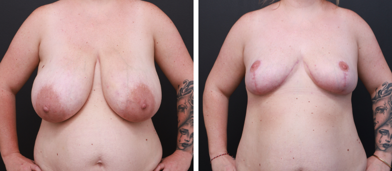 Results Shown: 6 Weeks Post Surgery | Plastic Surgeon: Dr Mike Yang