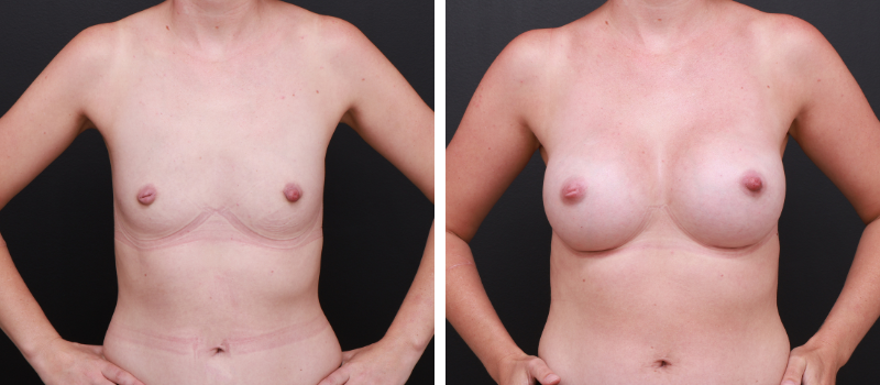 Shape: Motiva Ergonomix | Size: 340cc | Result Shown: 3 Months Post Surgery | Plastic Surgeon: Dr Mike Yang
