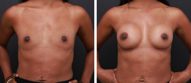 Shape: Motiva Ergonomix | Size: 430cc | Result Shown: 3 Months Post Surgery | Plastic Surgeon: Dr Mike Yang