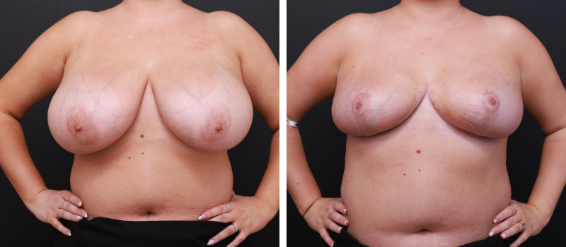 Results Shown: 2 Months Post Surgery | Plastic Surgeon: Dr Mike Yang