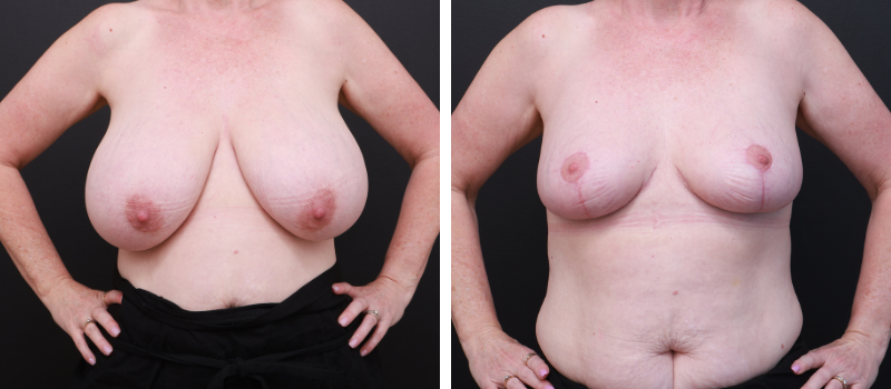 Results Shown: 3 Months Post Surgery | Plastic Surgeon: Dr Mike Yang